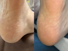 ガサガサかかと・タコ・魚の目をツルンと一掃！