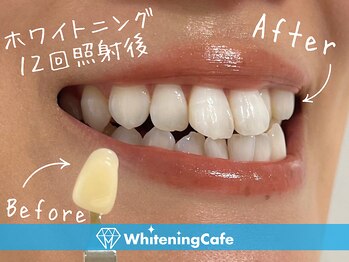 ホワイトニングカフェ 白山店(WhiteningCafe)/◎歯のホワイトニング施術写真◎