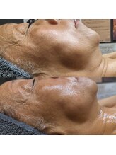 アルム(a'rme)/【たるみ】