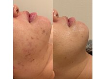 サロン ミジュ(salon MiJU)の雰囲気（ＮＭＮピーリング♪結果重視の肌質改善スタート！）