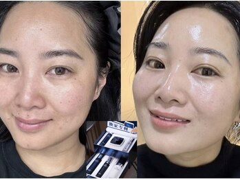 順蘭堂/韓国RE:Z肌管理ビフォーアフター