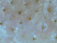 毛穴の汚れ1つ1つを、エクストラクション(手技)で取り除きます！