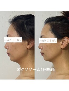 マニーク(MANIEQU)/エクソソーム
