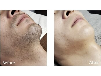 リッカ 学芸大学(RIKKA)/ひげ脱毛 ビフォーアフター