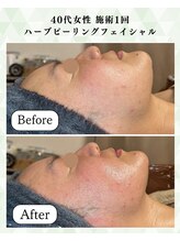 シーフェイス 横浜店(SEE FACE)/40代ハーブピーリングモニター