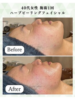 シーフェイス 横浜店(SEE FACE)/40代ハーブピーリングモニター