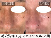 スキンジム(SKIN GYM)/毛穴・くすみ・シミ改善