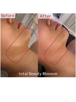 Blossom 【ホワイトニング/脱毛/韓国肌管理/毛穴洗浄】【3/23 NEW OPEN(予定)】/REDSHOT　顎下