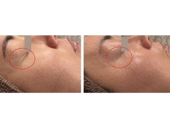 リリー(Lily.)/ハリ復元