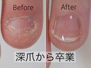 長年の深爪を整え爪を育てる