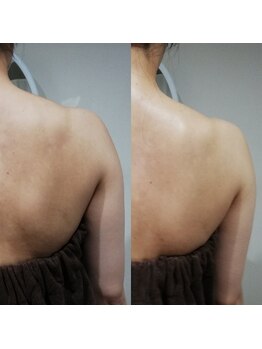 RiとBiのたまご/(ブライダル)背中・二の腕　引締