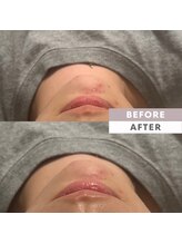 アトリエデザイン(atelier design)/【エステ】光フェイシャル