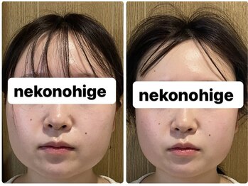 ねこのひげ/エラ張り浮腫み改善