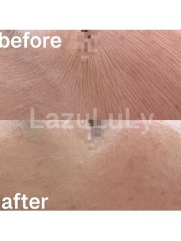 ラズリ(LazuLuLy)/乾燥/シワ/シミ/たるみ改善ケア