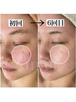 エメ(Aimer)/肌改善レストトリートメント