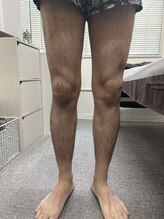 ブリッジ(BRIDGE)/メンズ全身脱毛初来店