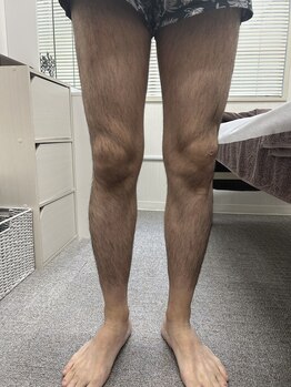 ブリッジ(BRIDGE)/メンズ全身脱毛初来店