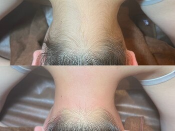 ゴールデンエイジ 吉祥寺(GOLDEN AGE)/ワックス脱毛 : 施術