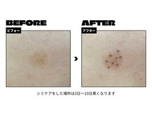 トムズ(Tom’s)/シミケアした直後の画像