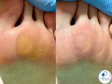 プラスワンフット 本厚木(+1 Foot)/タコ・魚の目ケア！痛みから解放