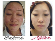 ハイケア グラン ギンザ(HYCARE GRAND GINZA)/日本ーの肌改善サロン実力/銀座