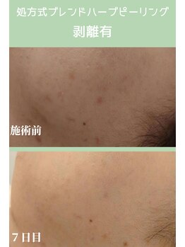 ハーシークレット(Her secret)/ブレンドハーブピーリング７日目