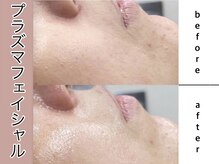 スリー(T.h.r.e.e.)/プラズマフェイシャル