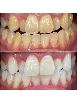 ホワイトニングサロン クルー(CREW)/セルフホワイトニングで