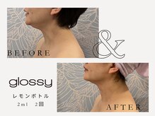グロッシー(glossy)/【症例レモンボトル顎下40代
