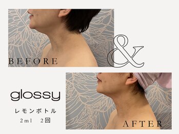 グロッシー(glossy)/【症例レモンボトル顎下40代
