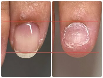 ブルームーンネイルズ(BLOOMOON.nails)/ずっと悩んでいた深爪から卒業！