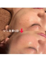 ウル(ulu)/無針水光注入