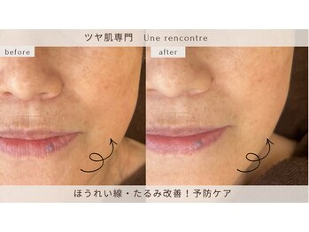 ユヌランコント 岐阜店(Une rencontre)の写真/年齢サインに負けない！たるみ、たるみ毛穴とほうれい線に集中ケア。肌を育てるエイジングケアで自信UP☆