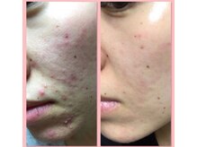 ハイケア グラン ギンザ(HYCARE GRAND GINZA)/日本ーの肌改善サロン実力/銀座