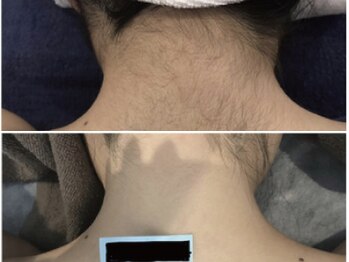 オーシャンブルー 佐世保店(OCEAN BLUE)/結果が出る脱毛【うなじ背面】