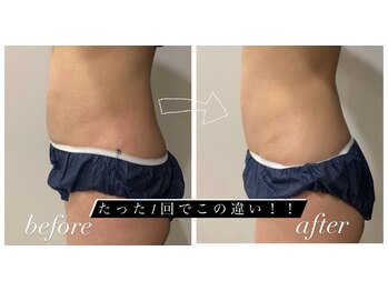 スパチャーレ(Spa ciare)/脂肪分解液を高速導入