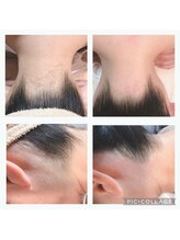 トータルビューティサロン リボーテ(Re:Beaute)/シュガーリング襟足