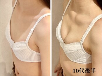 リール 新宿店(RIRE)/10代後半 バストアップ症例