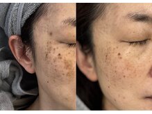 モガナ(mogana)/炭酸パック