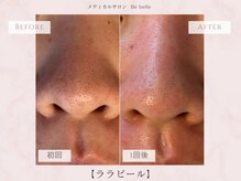 ビベル 八木店(Bebelle)/洗浄・毛穴の引き締めを同時ケア