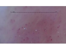 ぷめはな整体/施術前（毛細血管）