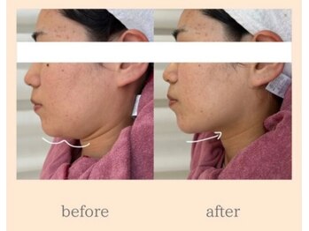 ナビ(NAVI)の写真/岩手初導入!本格たるみ機械で小顔に◎本場韓国で大人気の本格肌管理技術導入サロン!!