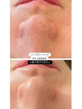 リセリュールサロン 東戸塚(RE:cellulesalon)/ハーブピーリングで毛穴ケア！