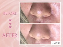 クリアラボ 上野(Clear Lab)/韓国肌管理&毛穴洗浄専門店