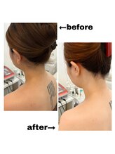 アプ(APP.)/うなじbefore→after♪（脱毛）