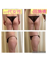 美活くらぶ/半身施術　　ビフォーアフター　