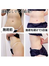 プレジール エテ(plaisir Ete)/施術５日後のお写真