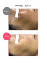 ボータン 恵(Beau Temps)/ウルトラ光トーニング/シミ改善