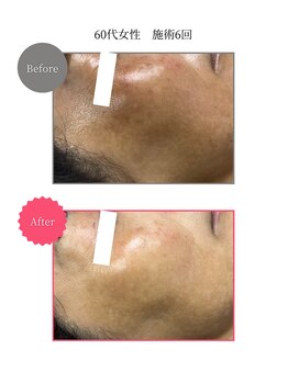 ボータン 恵(Beau Temps)/ウルトラ光トーニング/シミ改善