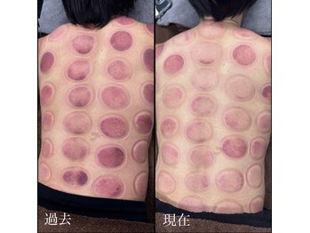 エムズビューティーサロン(M's Beauty Salon)/【5】カッピング